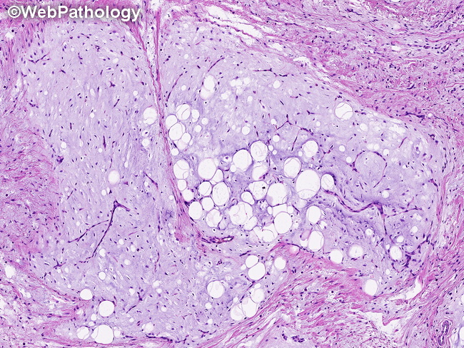 Soft Tissue_Lipomatous_Lipoblastoma36_resized.jpg